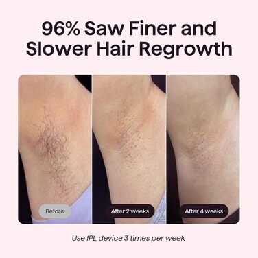 IPL пристрій для епіляції Wavytalk: безболісна епіляція для жінок та чоловіків, 24J, охолодження, збреєром, для обличчя, тіла, бікіні