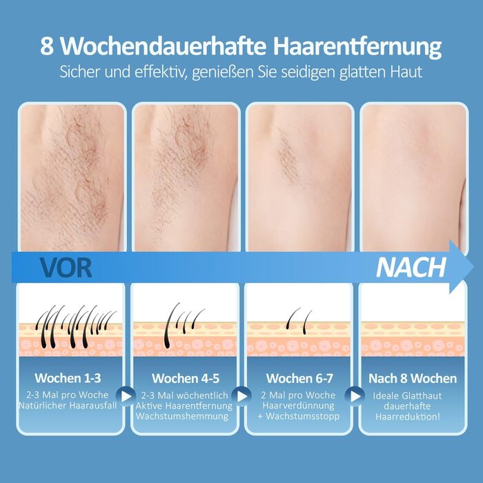 Пристрій для епіляції IPL з охолодженням та 999 999 імпульсів світла – лазерний епілятор з 5 рівнями енергії, для жінок/чоловіків/ногів/бікіні